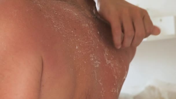 Esfoliação Pele Após Queimadura Solar Homem Arrancar Pele Com Uma — Vídeo de Stock