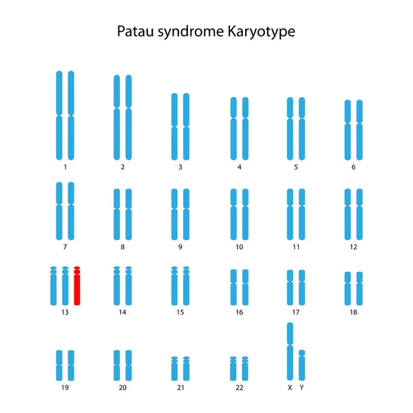 Síndrome Patau Trisomía Cariotipo Humano Masculino — Archivo Imágenes Vectoriales
