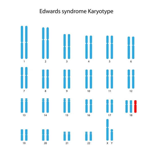 Síndrome Edwards Trisomía Cariotipo Humano Masculino — Vector de stock