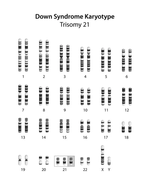 Down sendromu (trisomi 21) insan karyotipi