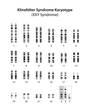 Klinefelter sendromu (XXY sendromu) karyotip.