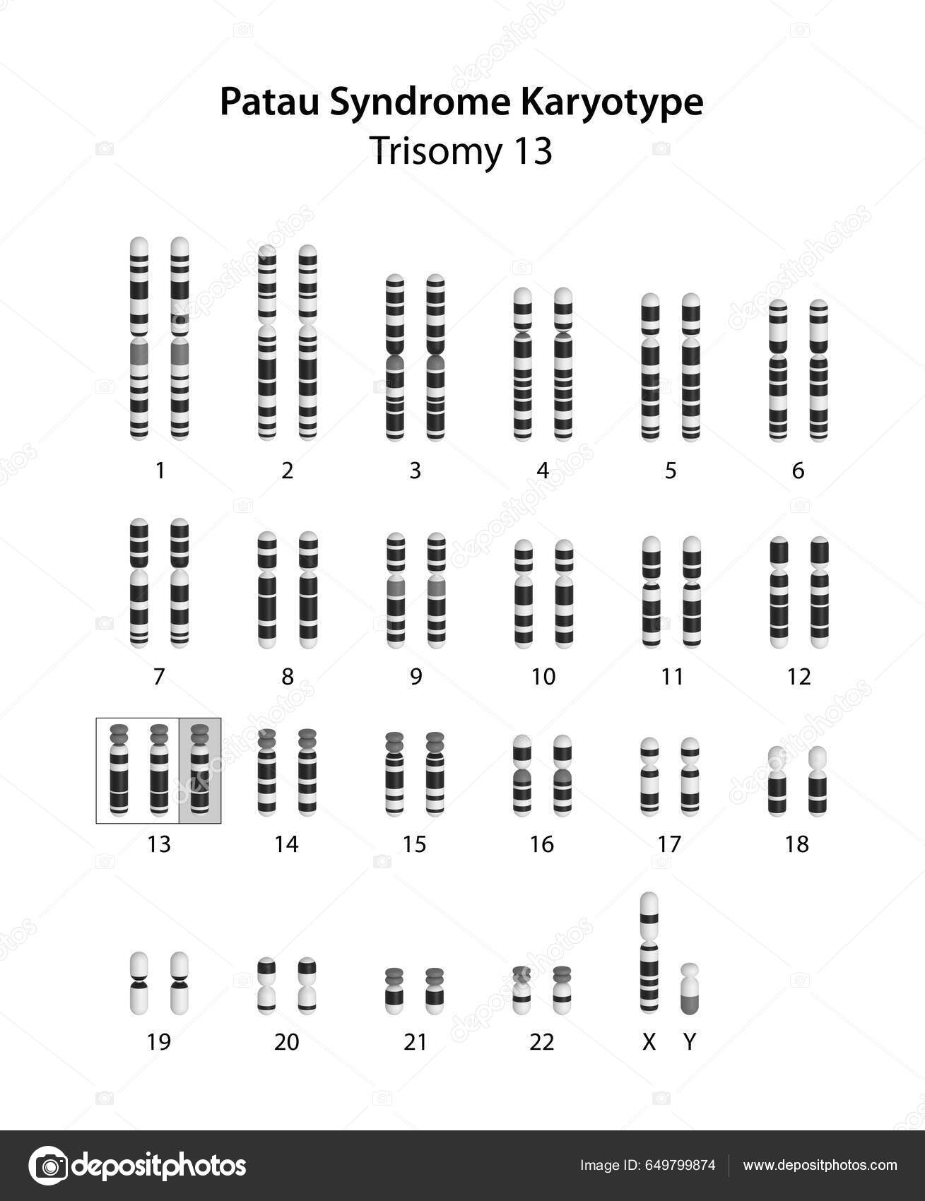 Patau Syndrome Karyotype