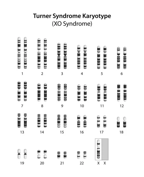 stock image Turner syndrome (X0) human karyotype