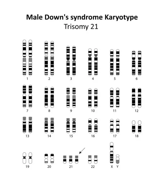 Erkek Down Sendromu (trisomi 21) insan karyotipi