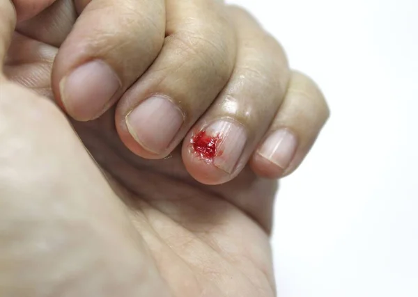 The ring finger nail that was cut by the knife, with the blood starting to coagulate.