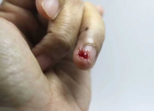 The ring finger nail that was cut by the knife, with the blood starting to coagulate.