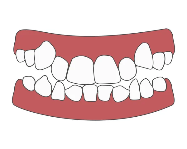 Ortodontyczne Problemy Zatłoczeniem Zębów Nieprawidłowe Erupcje Przeciwieństwo Niedrożności Otwarte Ugryzienie — Wektor stockowy