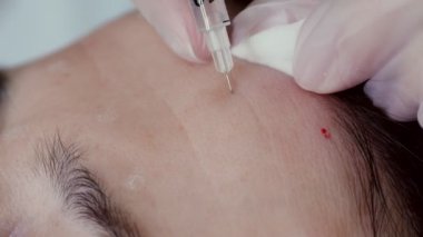 close-up. Doctor, in protective gloves, puts beauty injection to client forehead with syringe. Middle-aged woman gets beauty facial cosmetology procedure in healthcare clinic.