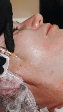 Güzellik iğnesi. Yaşlanma önleyici iğneler. Yüz tazeleme. Doktor güzellik iğneleri yapıyor. Yakın plan. Mezoterapi ve biyo-evitalleşme. Kolajen enjeksiyonları. Güzellik konsepti.
