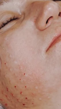 Güzellik iğnesi. Yaşlanma önleyici iğneler. Yüz tazeleme. Doktor güzellik iğneleri yapıyor. Yakın plan. Mezoterapi ve biyo-evitalleşme. Kolajen enjeksiyonları. Güzellik konsepti.