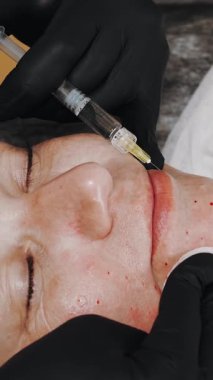 Güzellik iğnesi. Yaşlanma önleyici iğneler. Yüz tazeleme. Doktor güzellik iğneleri yapıyor. Yakın plan. Mezoterapi ve biyo-evitalleşme. Kolajen enjeksiyonları. Güzellik konsepti.