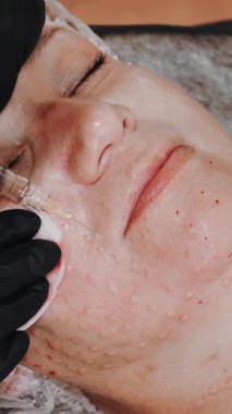 Güzellik iğnesi. Yaşlanma önleyici iğneler. Yüz tazeleme. Doktor güzellik iğneleri yapıyor. Yakın plan. Mezoterapi ve biyo-evitalleşme. Kolajen enjeksiyonları. Güzellik konsepti.