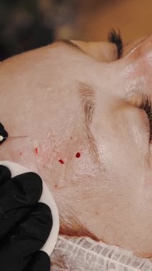 Güzellik iğnesi. Yaşlanma önleyici iğneler. Yüz tazeleme. Doktor güzellik iğneleri yapıyor. Yakın plan. Mezoterapi ve biyo-evitalleşme. Kolajen enjeksiyonları. Güzellik konsepti.