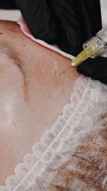 Güzellik iğnesi. Yaşlanma önleyici iğneler. Yüz tazeleme. Doktor güzellik iğneleri yapıyor. Yakın plan. Mezoterapi ve biyo-evitalleşme. Kolajen enjeksiyonları. Güzellik konsepti.