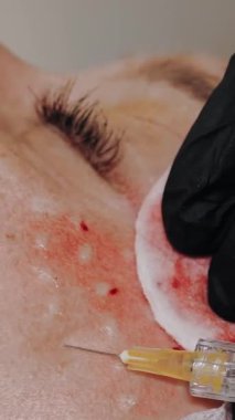 Güzellik iğnesi. Yaşlanma önleyici iğneler. Yüz tazeleme. Doktor güzellik iğneleri yapıyor. Yakın plan. Mezoterapi ve biyo-evitalleşme. Kolajen enjeksiyonları. Güzellik konsepti.