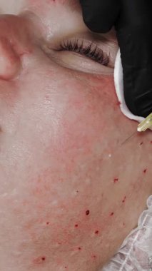 Güzellik iğnesi. Yaşlanma önleyici iğneler. Yüz tazeleme. Doktor güzellik iğneleri yapıyor. Yakın plan. Mezoterapi ve biyo-evitalleşme. Kolajen enjeksiyonları. Güzellik konsepti.