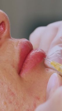 Yakın plan, kadın yüzü. Doktor, tıbbi eldivenlerde, alt kadın dudağına şırınga batırır ve yavaşça hyaluronik asit enjekte eder. Dudak büyütme prosedürü. Estetik ameliyat.