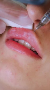 Yakın plan, kadın yüzü. Cerrah, tıbbi eldivenlerle üst kadın dudağına şırınga batırır ve yavaşça hyaluronik asit enjekte eder. Dudak büyütme prosedürü. Estetik ameliyat.