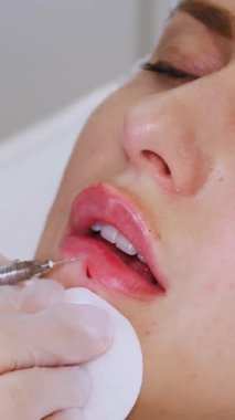 Yakın plan, kadın yüzü. Cerrah, tıbbi eldivenlerle kadının dudağına şırınga batırır ve yavaşça hyaluronik asit enjekte eder. Dudak büyütme prosedürü. Güzellik iğneleri. Estetik ameliyat.