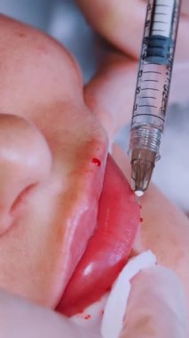 Dudak büyütme prosedürü. Yakın plan, kadın yüzü. Cerrah, tıbbi eldivenlerle kadının dudağına şırınga batırır ve yavaşça hyaluronik asit enjekte eder. Güzellik iğneleri. Estetik ameliyat.