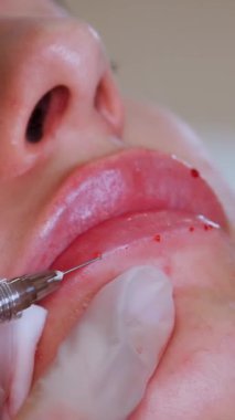 Dudak büyütme prosedürü. Yakın plan, kadın yüzü. Cerrah, tıbbi eldivenlerle kadının dudağına şırınga batırır ve yavaşça hyaluronik asit enjekte eder. Güzellik iğneleri. Estetik ameliyat.