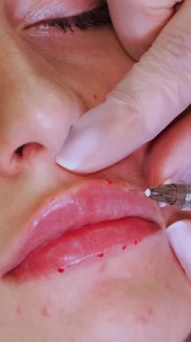 Dudak büyütme prosedürü. Yakın plan, kadın yüzü. Cerrah, tıbbi eldivenlerle kadının dudağına şırınga batırır ve yavaşça hyaluronik asit enjekte eder. Güzellik iğneleri. Estetik ameliyat.