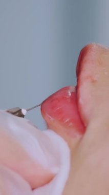 Dudak büyütme prosedürü. Yakın plan, kadın yüzü. Cerrah, tıbbi eldivenlerle kadının dudağına şırınga batırır ve yavaşça hyaluronik asit enjekte eder. Güzellik iğneleri. Estetik ameliyat.