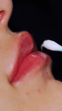 Yaklaş, dişi dudak. El, tıbbi eldiven, dudaklara yumuşatıcı dudak merhemi sürer. hyaluronik asit enjeksiyonu ile dudak büyütme prosedüründen sonra pamuk çubuğu ile..