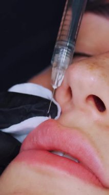 Yakın plan, kadın yüzü. Cerrah, tıbbi eldivenlerle üst kadın dudağına şırınga batırır ve yavaşça hyaluronik asit enjekte eder. Dudak büyütme prosedürü. Estetik ameliyat.