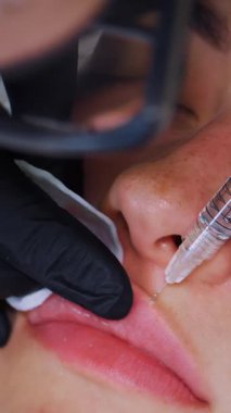 Yakın plan, kadın yüzü. Cerrah, tıbbi eldivenlerle üst kadın dudağına şırınga batırır ve yavaşça hyaluronik asit enjekte eder. Dudak büyütme prosedürü. Estetik ameliyat.