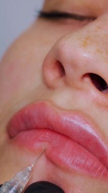 Yakın plan, kadın yüzü. Cerrah, tıbbi eldivenlerle kadının dudağına şırınga batırır ve yavaşça hyaluronik asit enjekte eder. Dudak büyütme prosedürü. Güzellik iğneleri. Estetik ameliyat.