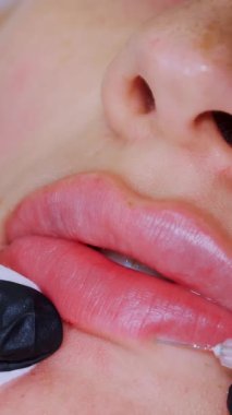 Yakın plan, kadın yüzü. Cerrah, tıbbi eldivenlerle kadının dudağına şırınga batırır ve yavaşça hyaluronik asit enjekte eder. Dudak büyütme prosedürü. Güzellik iğneleri. Estetik ameliyat.