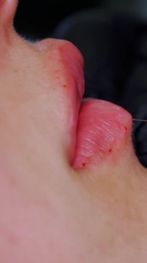 Yakın plan, dişi dudaklar.. Cerrah, tıbbi eldivenlerle kadının dudağına şırınga batırır ve yavaşça hyaluronik asit enjekte eder. Dudak büyütme prosedürü. Güzellik iğneleri. Estetik ameliyat.