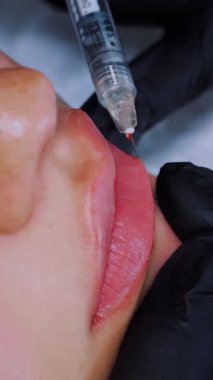 Yakın plan, kadın yüzü. Cerrah, tıbbi eldivenlerle kadının dudağına şırınga batırır ve yavaşça hyaluronik asit enjekte eder. Dudak büyütme prosedürü. Güzellik iğneleri. Estetik ameliyat.