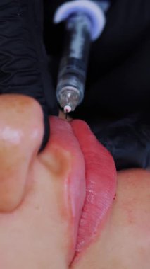 Yakın plan, kadın yüzü. Cerrah, tıbbi eldivenlerle kadının dudağına şırınga batırır ve yavaşça hyaluronik asit enjekte eder. Dudak büyütme prosedürü. Güzellik iğneleri. Estetik ameliyat.