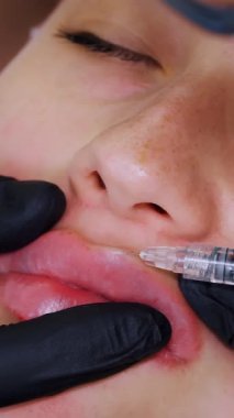 Yakın plan, kadın yüzü. Cerrah, tıbbi eldivenlerle kadının dudağına şırınga batırır ve yavaşça hyaluronik asit enjekte eder. Dudak büyütme prosedürü. Güzellik iğneleri. Estetik ameliyat.