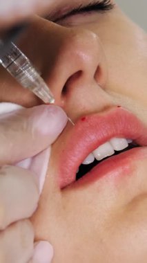Yakın plan, kadın yüzü. Cerrah, tıbbi eldivenlerle kadının dudağına şırınga batırır ve yavaşça hyaluronik asit enjekte eder. Dudak büyütme prosedürü. Güzellik iğneleri. Estetik ameliyat.