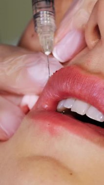 Close-up, female lips. Surgeon, in medical gloves, carefully and slowly injects hyaluronic acid into woman's lips with a syringe. lip augmentation procedure. beauty injections. Plastic surgery.