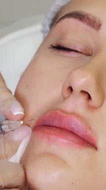 Yakın plan, kadın yüzü. Cerrah, tıbbi eldivenlerle kadının dudaklarına dikkatlice ve yavaşça hyaluronik asit enjekte ediyor. Dudak büyütme prosedürü. Güzellik iğneleri. Estetik ameliyat.
