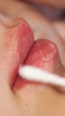 Yaklaş, dişi dudak. El, tıbbi eldiven, dudaklara yumuşatıcı dudak merhemi sürer. hyaluronik asit enjeksiyonu ile dudak büyütme prosedüründen sonra pamuk çubuğu ile..