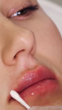 Yaklaş, dişi dudak. El, tıbbi eldiven, dudaklara yumuşatıcı dudak merhemi sürer. hyaluronik asit enjeksiyonu ile dudak büyütme prosedüründen sonra pamuk çubuğu ile..
