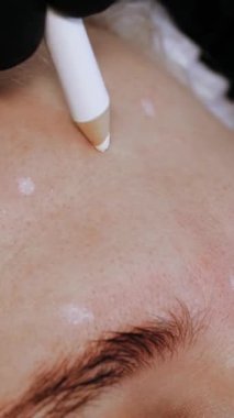 Güzellik iğnesi. Yaşlanma önleyici iğneler. Botulinum terapisi. Yüz tazeleme. Doktor, hastanın alnına güzellik iğneleri için işaretler yapıyor. Kolajen enjeksiyonları. Güzellik konsepti.