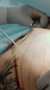 Yakın plan. Karın yağlarını aldırma, ameliyathane ortamında ameliyat eldivenli cerrahları gösteriyor. Kanülle yağ pompalıyor. Minimum invazif ameliyat.