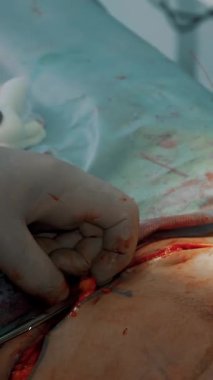 Estetik ameliyat. Yakın plan. Cerrah, abdominal liposuction sonrası hastanın karnına büyük bir kesik atar..