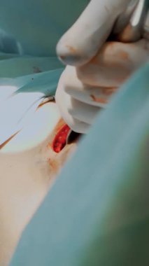 Yakın plan. Cerrah silikon göğüs implantı için bölgeyi temizliyor. Göğüs büyütme estetiği. Mammaplasti. Göğüs kanseri