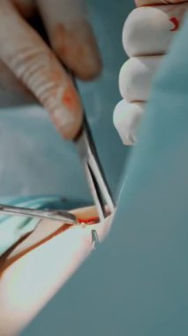 Yakın plan. Cerrah silikon göğüs implantı için bölgeyi temizliyor. Göğüs büyütme estetiği. Mammaplasti. Göğüs kanseri