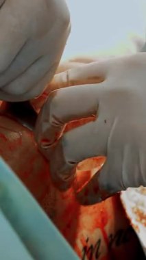 Yakın plan. Cerrah, tıbbi eldivenlerle silikon implantı iyot çözeltisiyle tedavi ediyor ve göğüs derisinin altına itiyor. Göğüs büyütme estetiği. Mamaplasti..