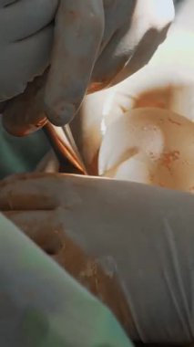 Yakın plan. Cerrah, tıbbi eldivenlerle silikon implantı iyot çözeltisiyle tedavi ediyor ve göğüs derisinin altına itiyor. Göğüs büyütme estetiği. Mamaplasti..