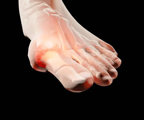 Подагра Является Распространенной Формой Воспалительного Артрита Пальцах Ног Человека — стоковое фото