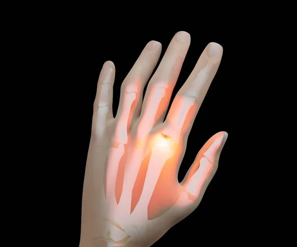 Gut Eklem Iltihabı Eklem Ağrısı Parmak Ağrısı Nsan Kemiği Anatomisi — Stok fotoğraf